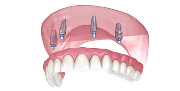 Dental implant model showing three titanium posts anchored in pink gum tissue supporting artificial teeth.