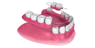 Dental implant model showing teeth arrangement on pink gum base with implant posts