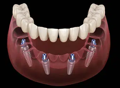 Dental implant model showing prosthetic teeth anchored to jawbone with four titanium implants.
