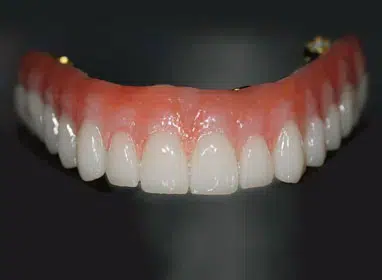 Dental prosthetic model showing upper teeth with pink gum tissue and white tooth restorations against dark background.
