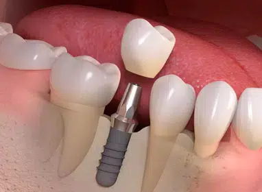 Dental implant model showing tooth replacement procedure with crown and fixture components on pink gum base.
