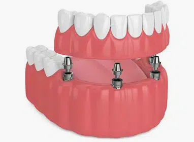Dental implant model showing prosthetic teeth and metal implant posts in pink gum base.
