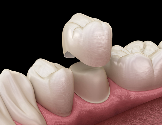 Dental crown placement illustration showing tooth preparation and ceramic crown restoration on gum model.
