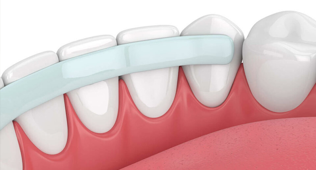 Dental crown placement illustration showing tooth restoration over natural teeth and gums.