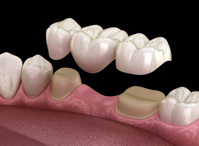 3D dental illustration showing tooth implants and crowns on pink gum model against black background.