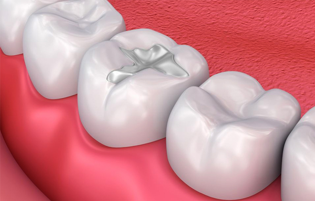 3D dental illustration showing white teeth with cavities on pink gum tissue background.