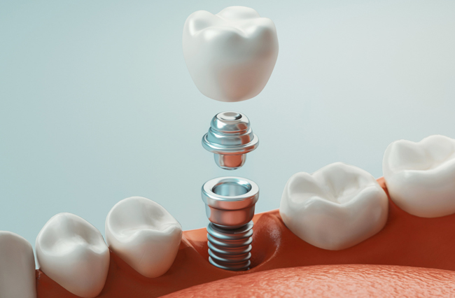 Dental implant components displayed between model teeth showing crown, abutment, and screw assembly.