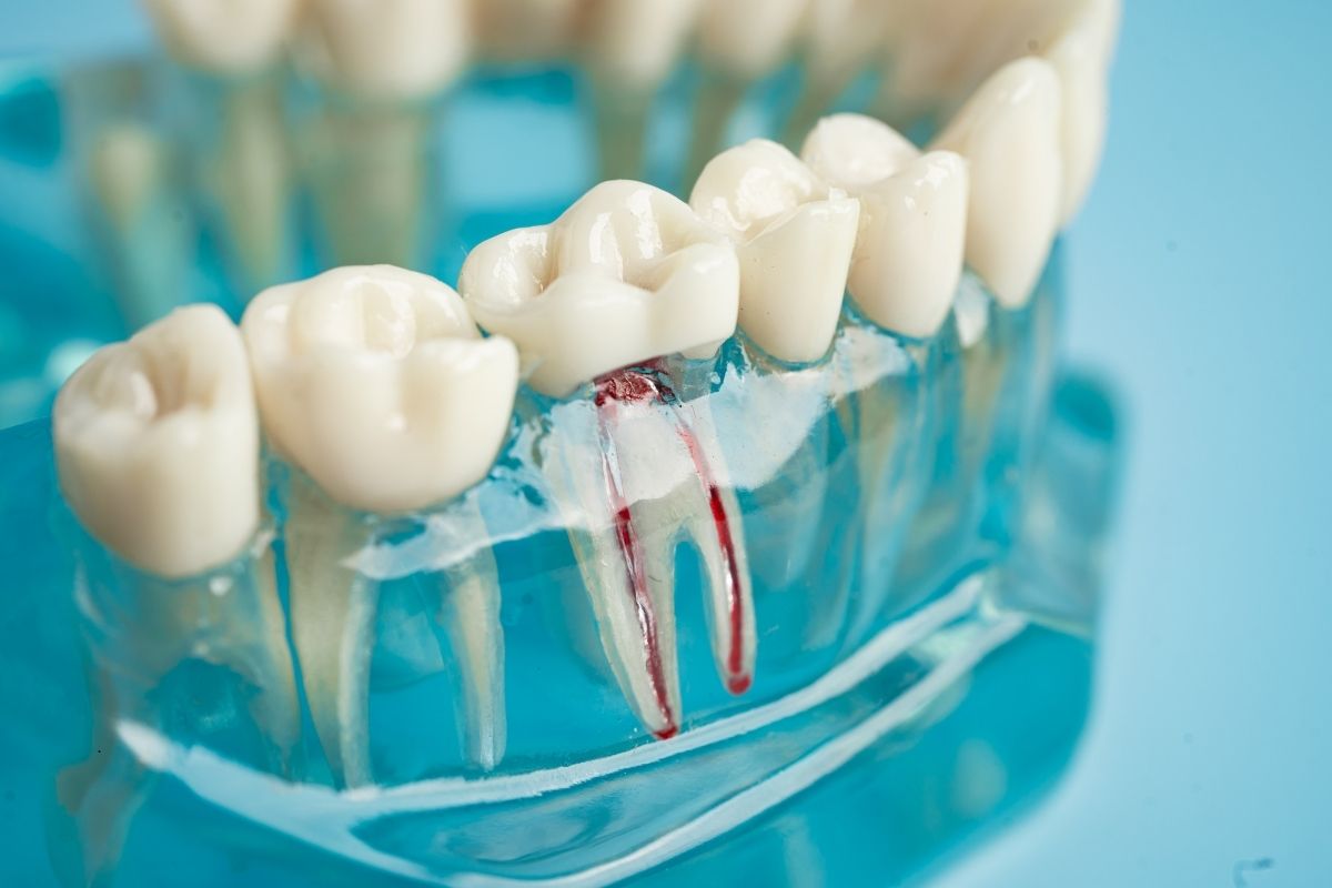 10 Things You Should Know About Root Canals