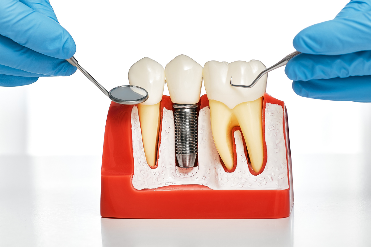 Considering Dental Implants? 3 Important Things You Should Know