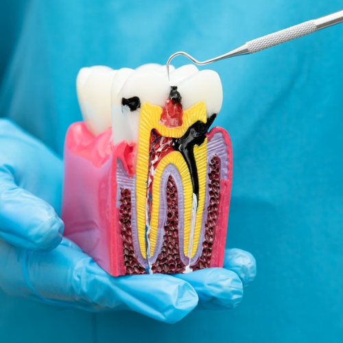 What to Expect During Your Root Canal Treatment