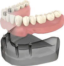 Dental implant model showing prosthetic teeth attachment on jawbone structure for implant dentistry education.