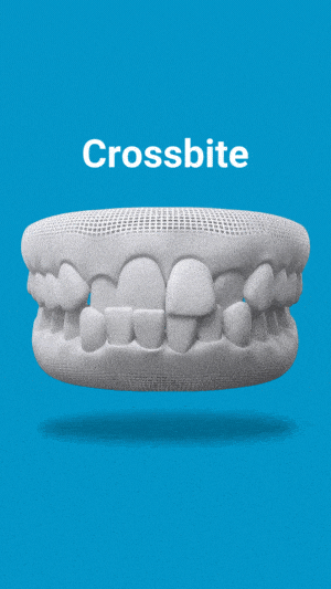 3D model of dental model showing crossbite malocclusion on blue background