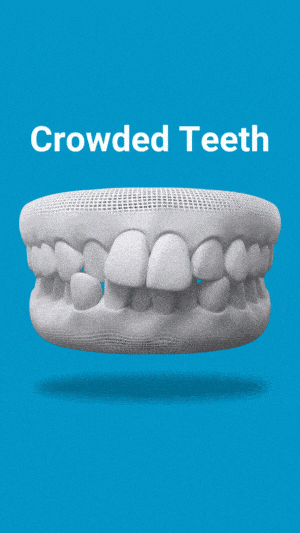 3D dental model showing crowded teeth misalignment on blue background with label