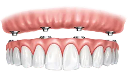 Dental implant prosthetic showing pink gum model with white artificial teeth restoration.