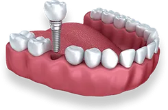 Dental implant model showing titanium screw and artificial tooth crown on gum replica.