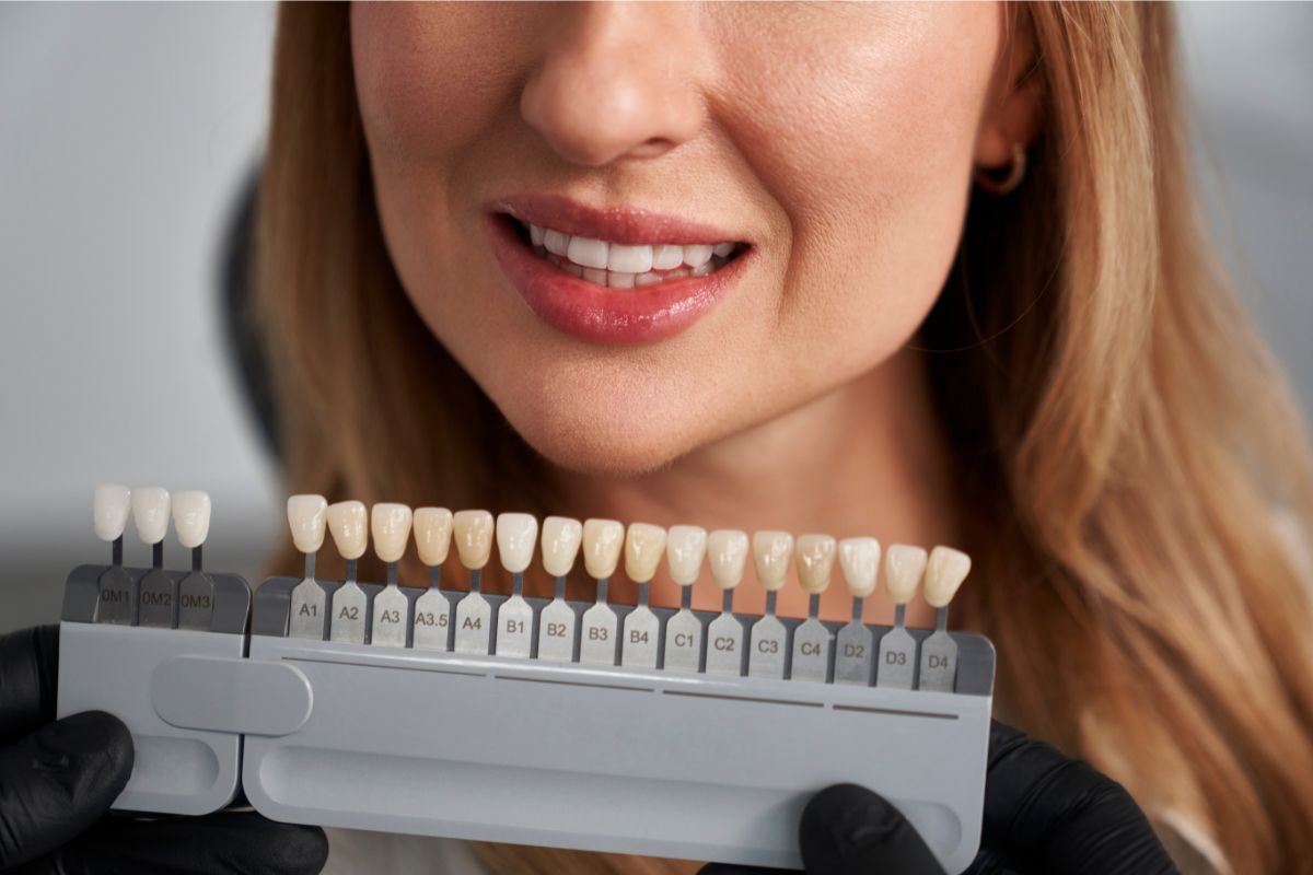 Does Teeth Whitening Work on Veneers? What You Need to Know